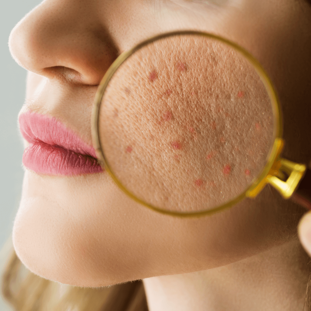 collection of products for treatment acne and blemishes